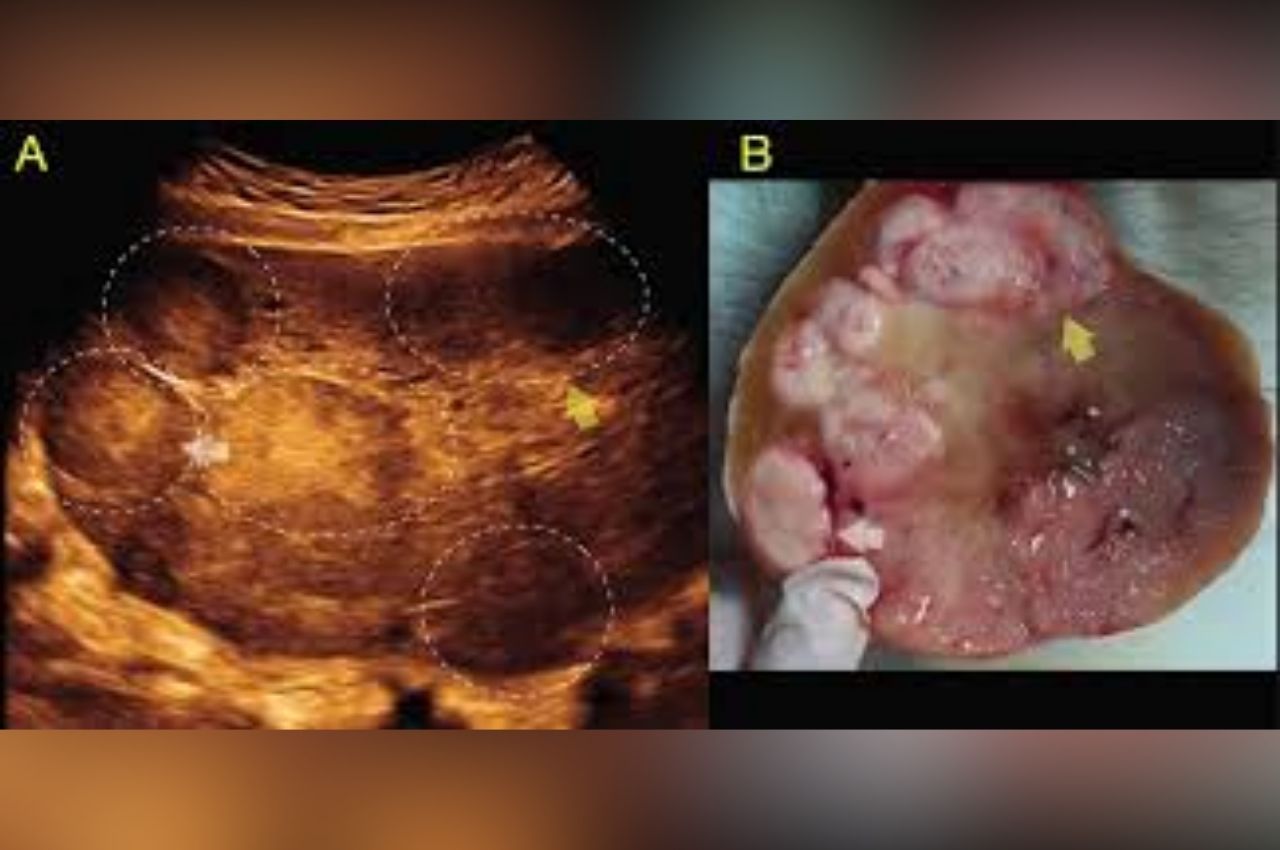 Mengenal Disgerminoma: Kanker Sel Germinal pada Wanita Muda